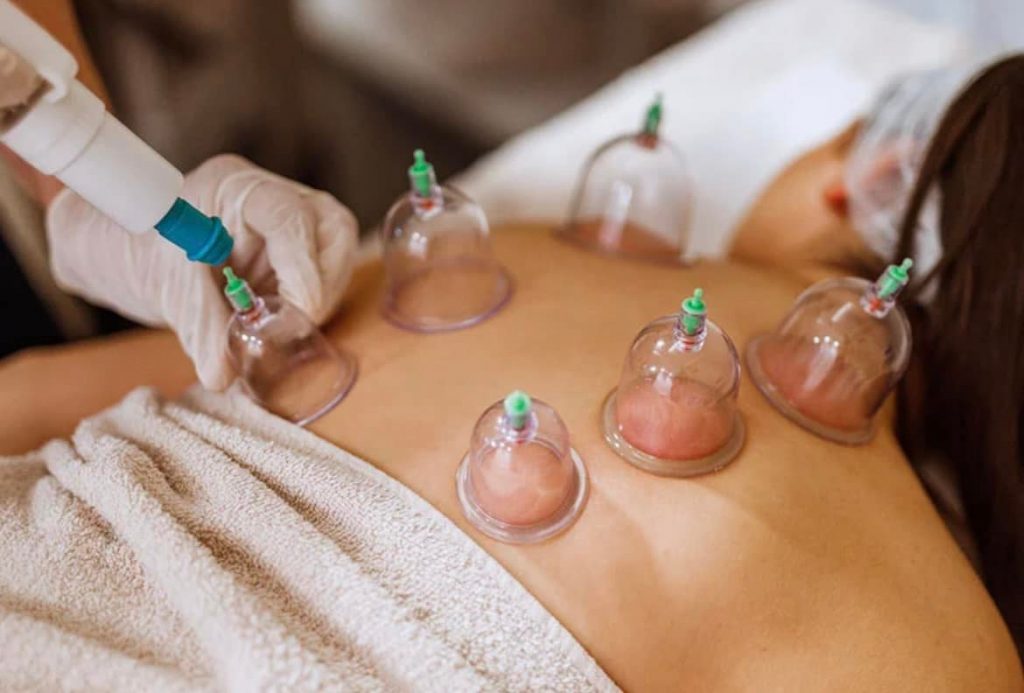 cupping