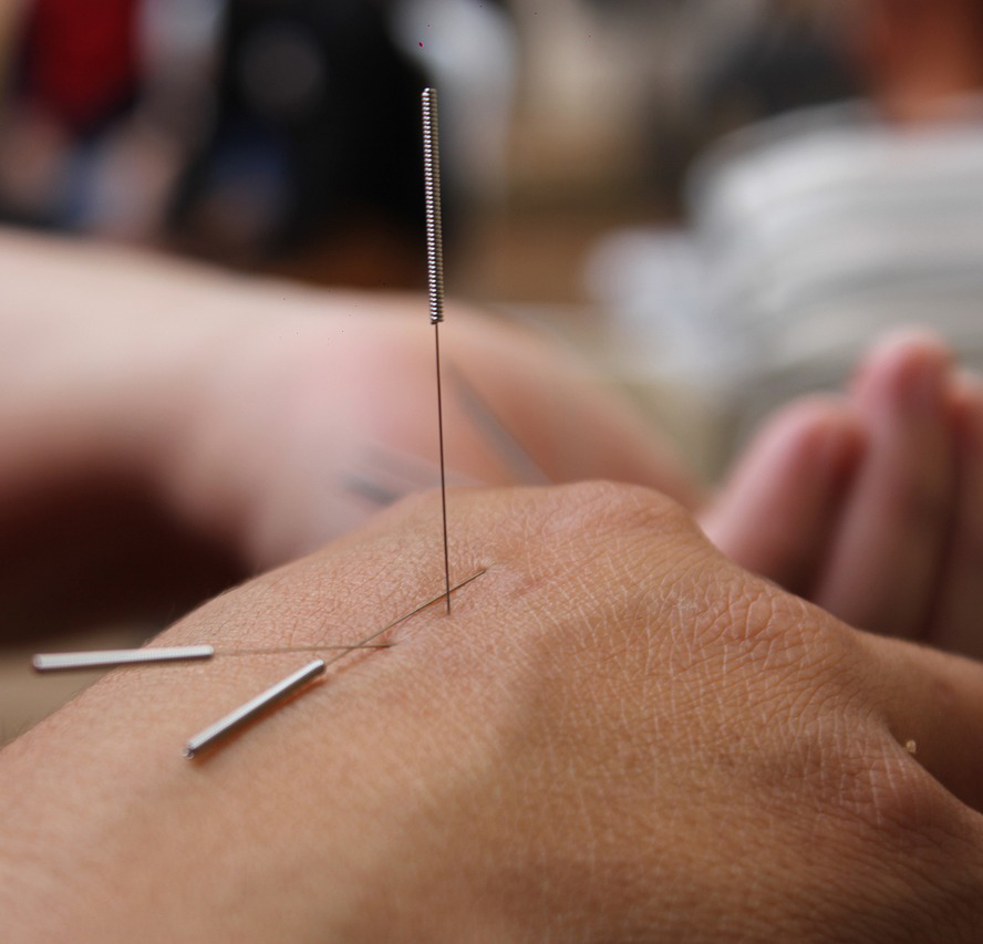 acupuncture2